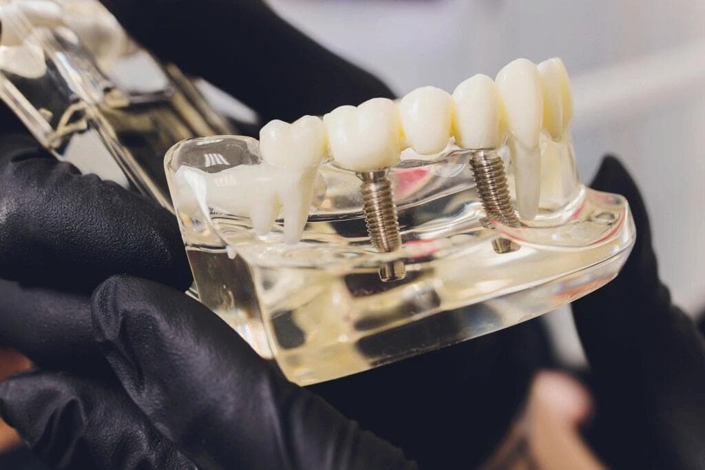 Gloved hands holding a clear dental model of a jaw with implants